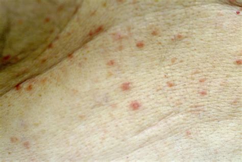 Pathology Outlines Transient Acantholytic Dermatosis