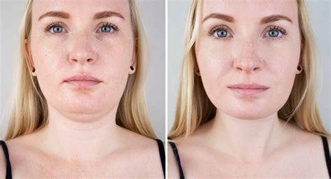 double chin removal causes prevention treatment dr donath