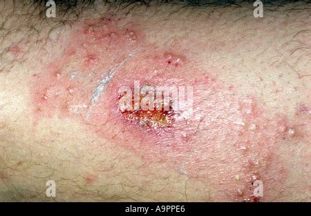 Cutaneous Leishmaniasis Skin Lesion Stock Photo Alamy