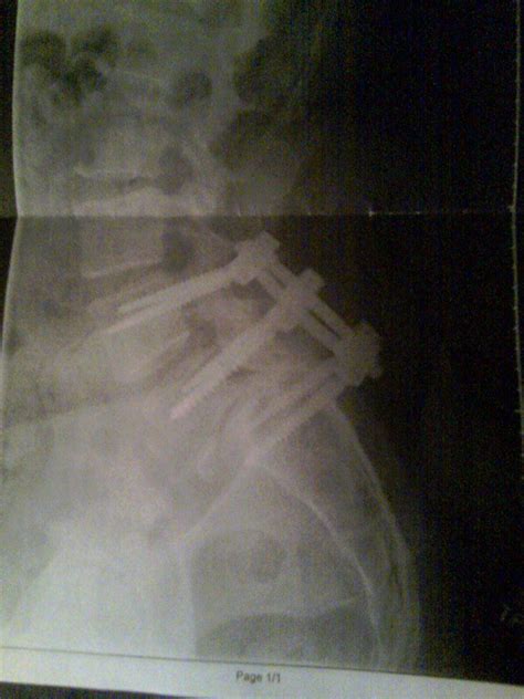 Side View Of L4 L5 S1 Plif Spinal Fusion Using 6 Pedicle Screws And 4