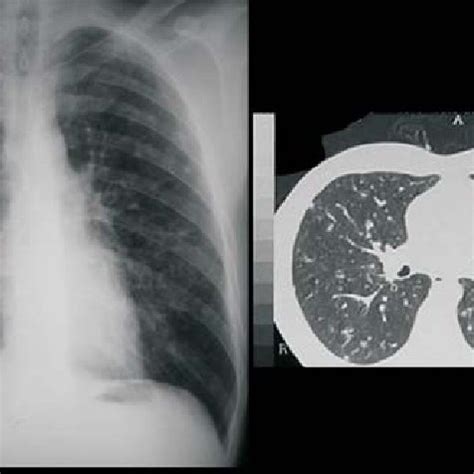 Chest X Ray Showing Multiple Focal Nodules Distributed Throughout Both