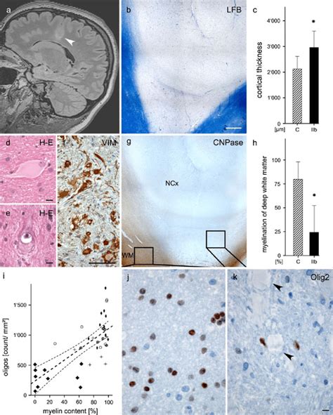 Comprehensive Neuropathology And Imaging Findings In Fcd Type Iib A