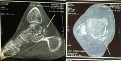 Cureus A Rare Case Of Fractured Posterior Facet Of The Talus In