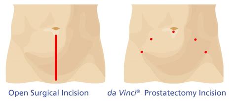 Da Vinci Robotic Prostatectomy Prostate Cancer Solution