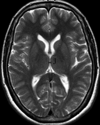 Axial T Weighted Tse Mri Tr Te Ms Of Measurement Site Of