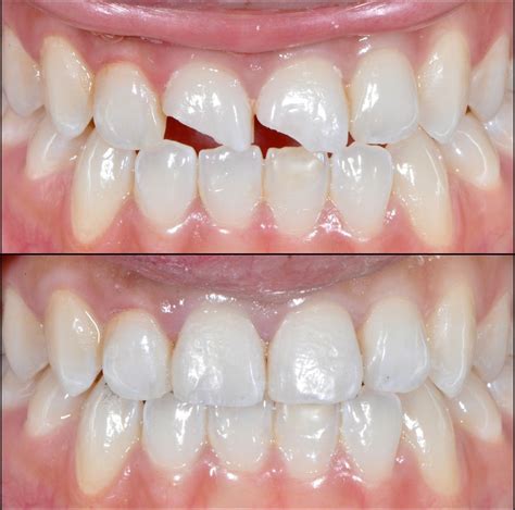 Anterior Composite Restoration Dental Veneers Dental Cosmetics