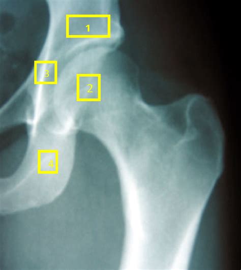 The Natural History Of Bone Bruise And Bone Remodelling In The