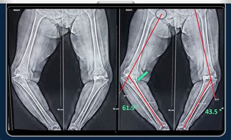 Medial Release In Severe Varus Knee Deformity Cases Orthopedic