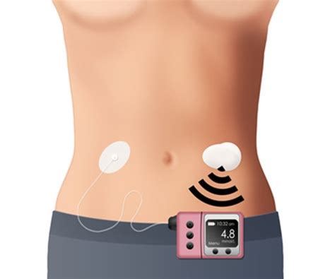 Schneller versand ✓ günstiger preis ✓. With Same Training, Insulin Pumps No Better than ...