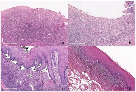 Gingival Hyperplasia Histology