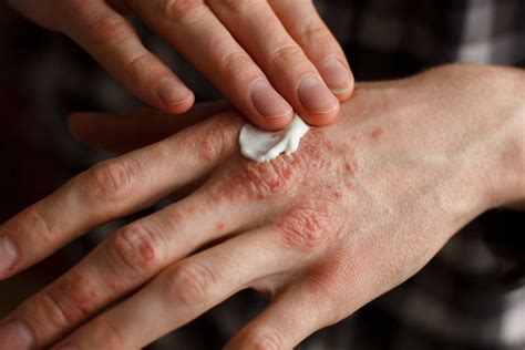 Benvitimod Cream A New Topical Treatment For Plaque Psoriasis