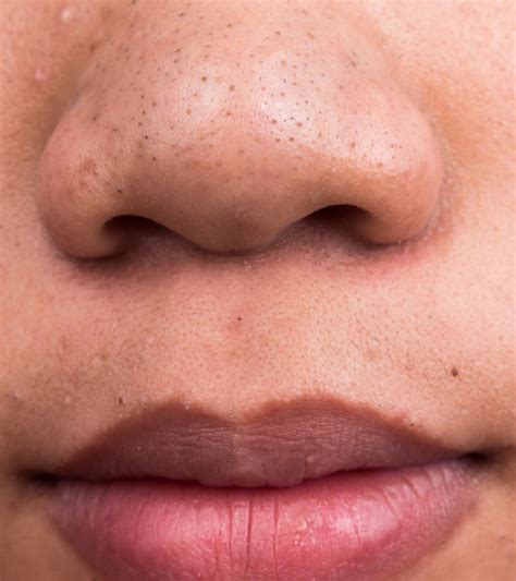 How To Get Rid Of Blackheads On The Chin Easily At Home