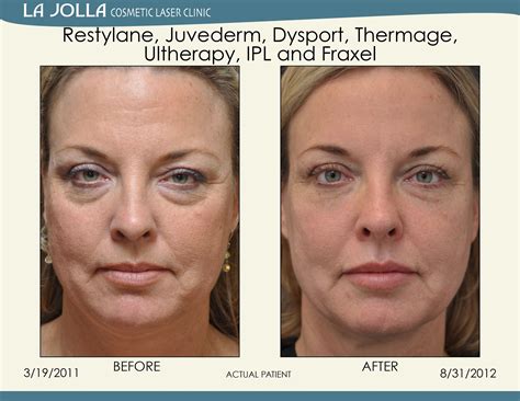 Patient Treated With Restylane Juvederm Dysport Thermage Ultherapy