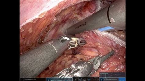 Robotic Restorative Total Proctocolectomy With Ileal J Pouch And Diverting Loop Ileostomy Youtube