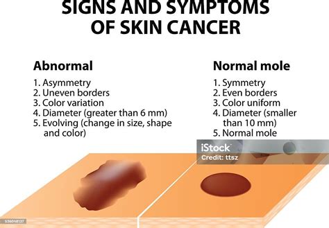 Signs And Symptoms Of Skin Cancer Stock Vector Art 536048137 Istock