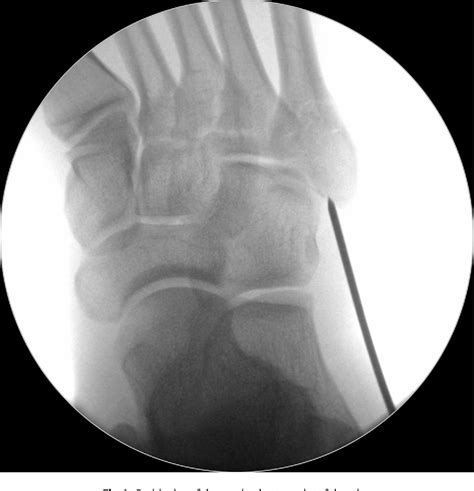 Figure 1 From Guide Wire Placement For Fifth Metatarsal Intra Medullary Screw Fixation A
