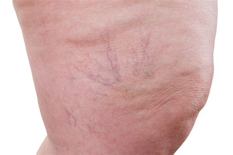 Varicose Veins Closeup Female Legs Isolated On White Background Stock