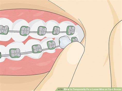 3 Ways To Temporarily Fix A Loose Wire On Your Braces Wikihow