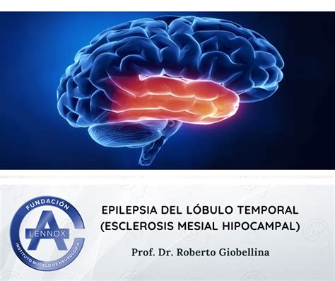 Epilepsia del Lóbulo Temporal Esclerosis Mesial Hipocampal Instituto Lennox