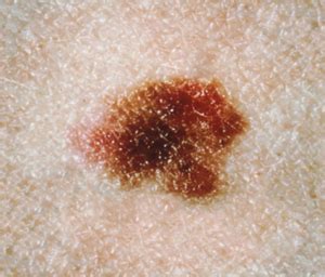 Check spelling or type a new query. Can a Normal Mole Look Like a Melanoma? » Scary Symptoms