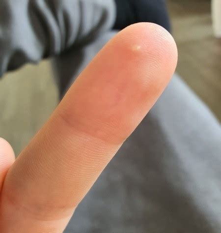 This Pimple Thing On My Finger Arrived For No Had No OFF