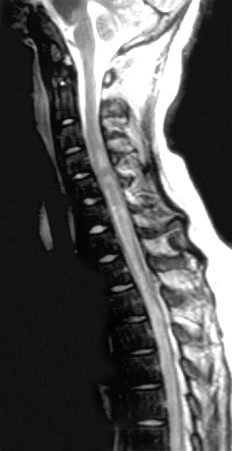 Acute Severe Spinal Cord Dysfunction In Bacterial Meningitis In Adults