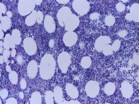 Bone Marrow Biopsy Pure Red Cells Aplasia Associate With Malignant