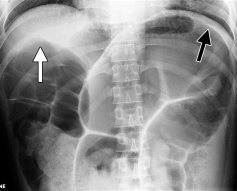 Large Bowel Obstruction In The Adult Classic Radiographic And Ct