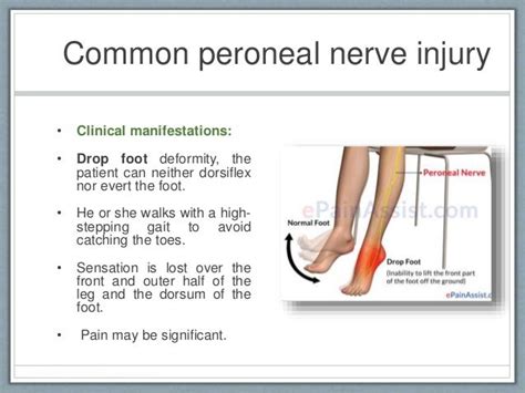 Peroneal Nerve Palsy Foot Drop