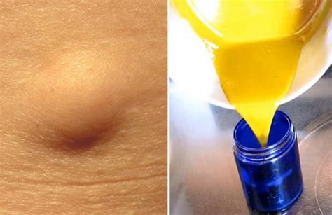 Get Rid Of Lipomas Forever With This Fantastic Homemade Remedy Skin