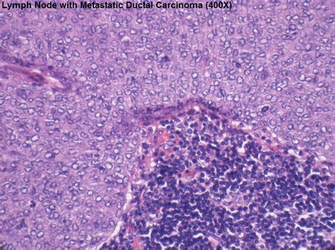 H Lymph Node With Metastatic Ductal Carcinoma 400x