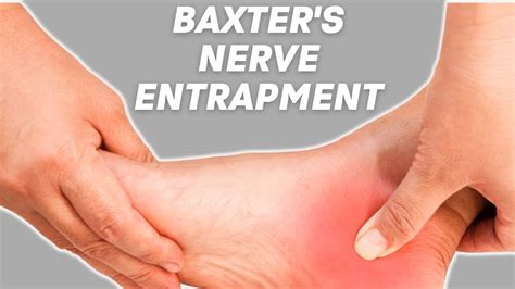 Complete Overview Of Baxters Nerve Entrapment By Physical Therapists