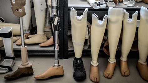 New Prosthetics That Connect Right To The Bone Let Amputees Feel Again