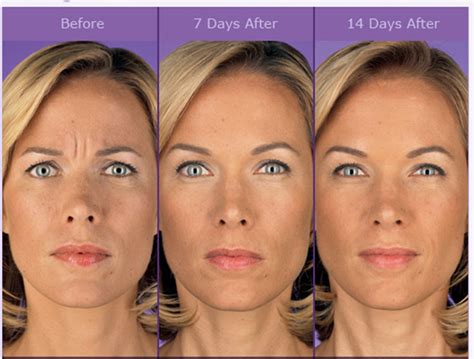 Botox Cosmetic Is The Leading Injectable Treatment At Faces Med Spa