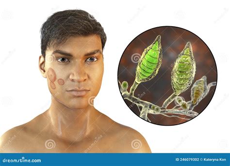 Fungal Infection On A Man S Face 3d Illustration Tinea Faciei Caused