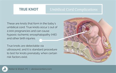 True Knot In Umbilical Cord Risk Factors Signs Diagnosis And