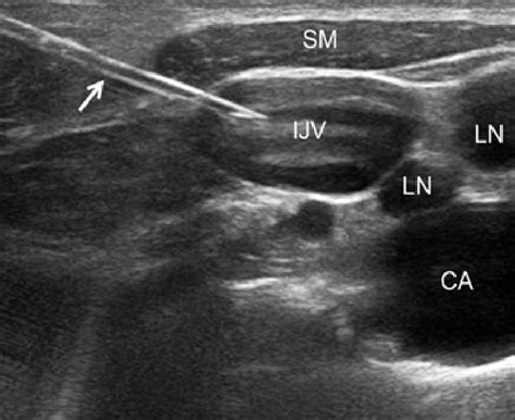 Short Axis Lateral In Plane Technique Ultrasound Image Of The Right