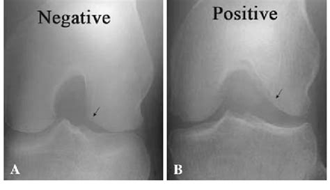 A B Tunnel View Radiographs Show A Negative And B Positive Cutoff