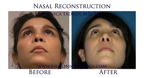 Nasal Reconstruction In Nj And Nyc Nose Reconstruction Surgery