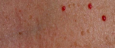 I Have Spots On My Skin Which Release Small Amounts Of Blood And Are