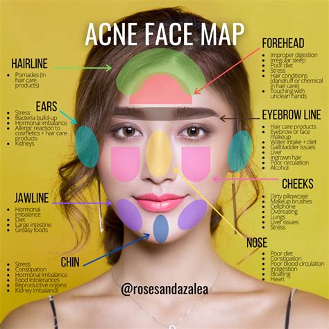Acne Face Map In 2020 Face Mapping Acne Face Acne Fac
