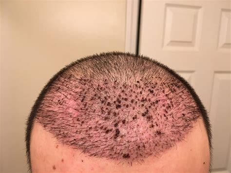 Redness After Hair Transplant How To Deal With It Cosmedica