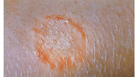 Nummular Eczema Vs Ringworm Symptoms Causes And Treatment A41