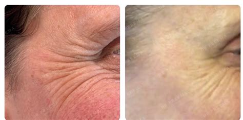 Wrinkle Relaxing Dr Preema London Clinic