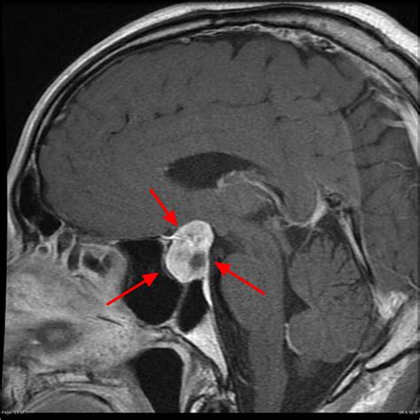 pituitary tumor signs symptoms diagnosis mri surgery and treatment