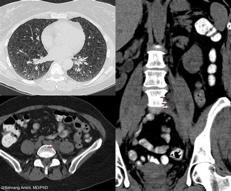 Roentgen Ray Reader Lymphangioleiomyoma