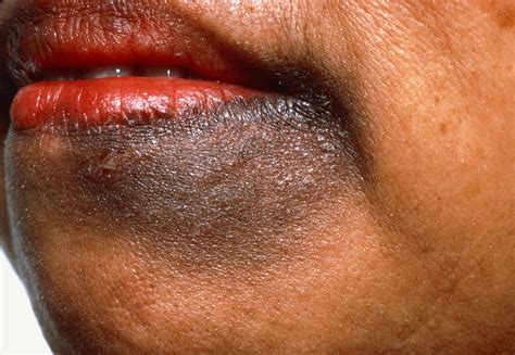 Common Skin Conditions In People Of Color Identification And Treatment