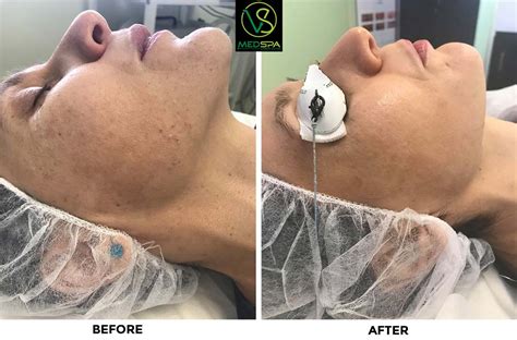 So in case you've ever wondered what to expect from ipl (and fyi it's not laser) then this video is for you. IPL PhotoFacial Treatment | VS MedSpa Laser Hair Removal Clinic
