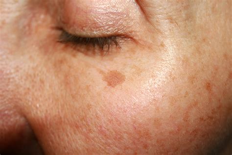 Brown Spots Under The Eye Pigmentation On The Face Ozmedica