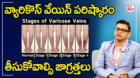 Dr Rajah About Varicose Veins Stages Varicose Veins Symptoms